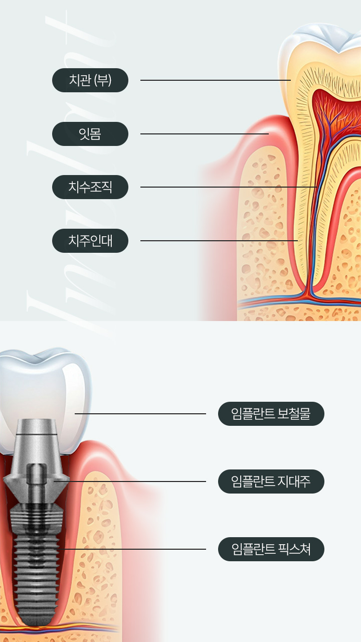 임플란트